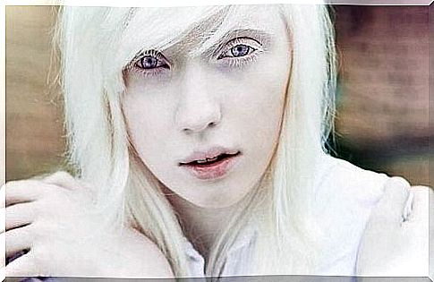 Albino people: beyond the physical aspect