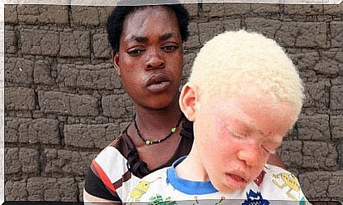 albino people